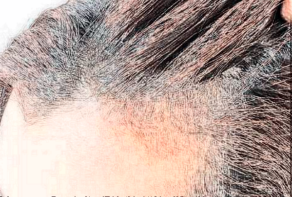 太原市中心醫(yī)院植發(fā)怎么樣_哪個醫(yī)生比較好