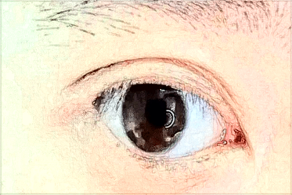 2024中山大學(xué)附屬第三醫(yī)院近視手術(shù)多少錢?近視手術(shù)有風(fēng)險嗎