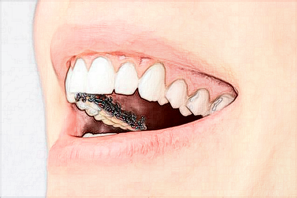 2024珠海市人民醫(yī)院拔掉智齒多少錢?拔掉智齒會(huì)瘦臉嗎