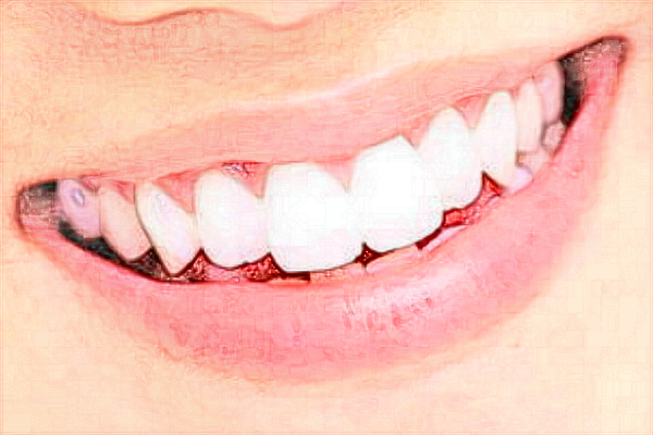 常德市第一人民醫(yī)院洗牙怎么樣?洗牙對(duì)牙齒有什么影響