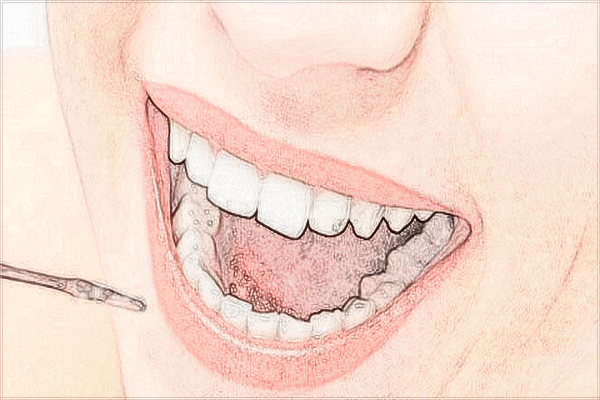 2024武漢大學(xué)口腔醫(yī)院烤瓷牙價(jià)格?烤瓷牙怎么樣?