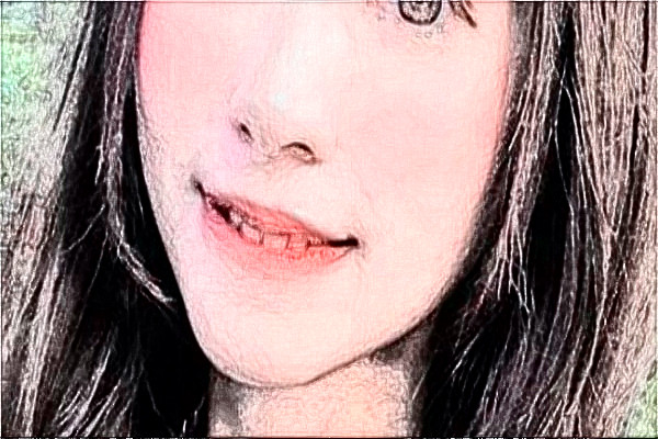 安徽省立醫(yī)院玻尿酸價(jià)格多少?貴不貴