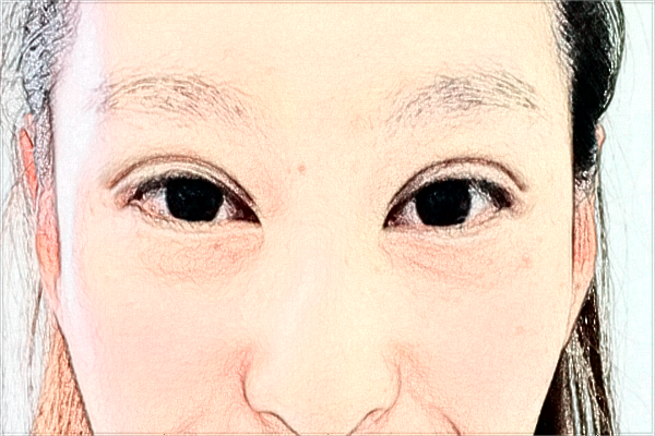 天津市醫(yī)科大學眼科醫(yī)院近視怎么樣_整形日記分享