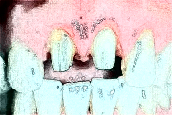 2024青島市立醫(yī)院拔智齒怎么樣?拔智齒收費(fèi)價(jià)目表