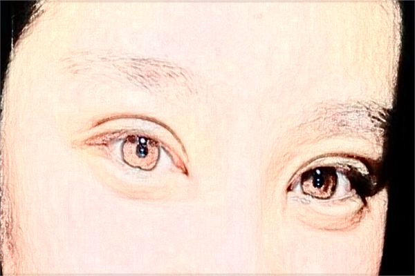 2024大連醫(yī)科大學(xué)附屬第一醫(yī)院做雙眼皮做的好嗎_醫(yī)生技術(shù)好不好