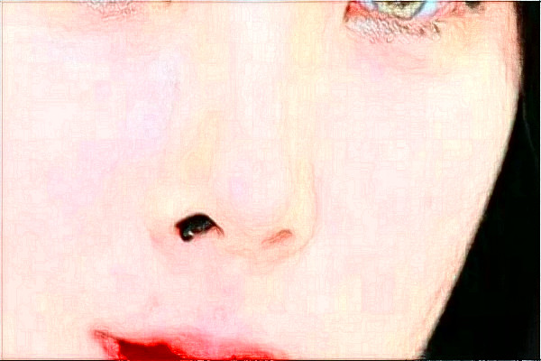 2024天津醫(yī)科大學(xué)總醫(yī)院可以去胎記嗎？去胎記真實案例