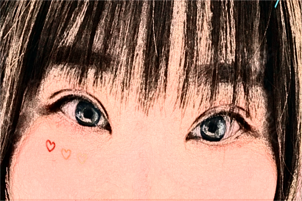 2024大連醫(yī)科大學(xué)附屬第一醫(yī)院做雙眼皮做的好嗎?整形日記分享