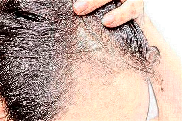 青島市立醫(yī)院植發(fā)靠譜么?植發(fā)的危害和后遺癥