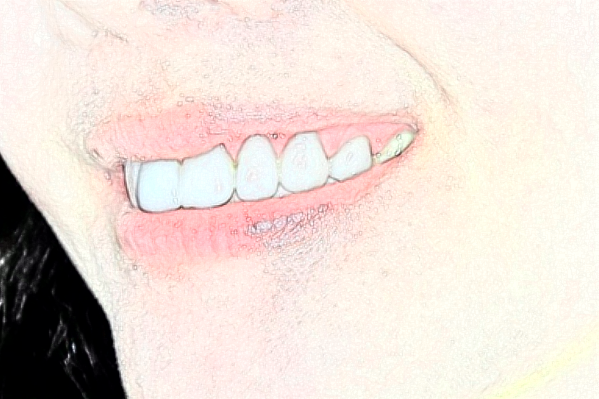 大連新華醫(yī)院口腔科牙列擁擠做的怎么樣_誰(shuí)做的比較好