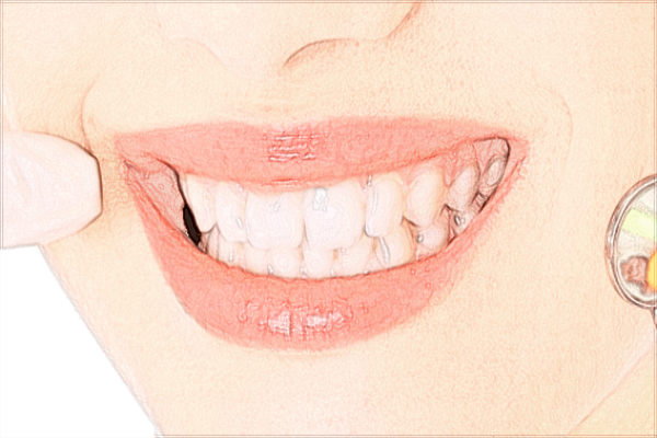 2024泉州180醫(yī)院拔牙貴嗎?拔牙后多久可以安假牙