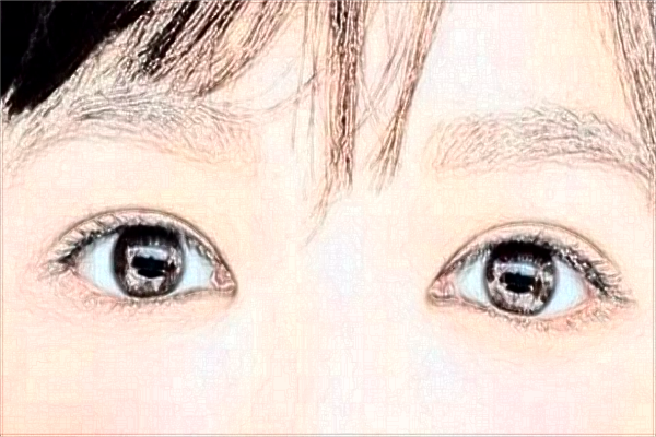 2024吉林大學第一醫(yī)院全飛秒做的好嗎?誰做得好