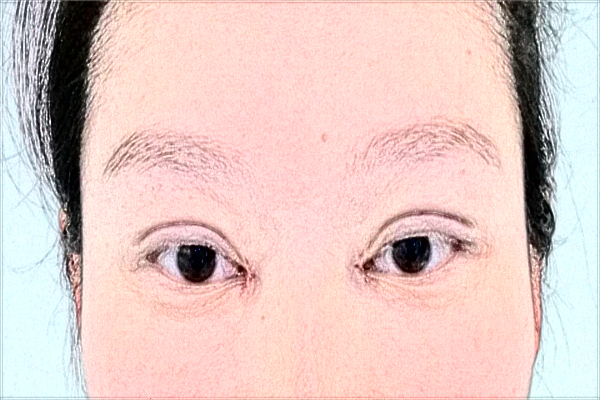 2024延邊醫(yī)院半飛秒做的好嗎?誰做得好