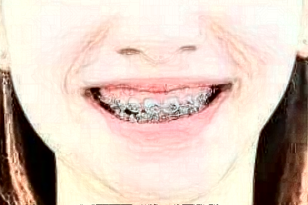 2024南京鼓樓醫(yī)院牙齒矯正價目表(價格表)怎么樣