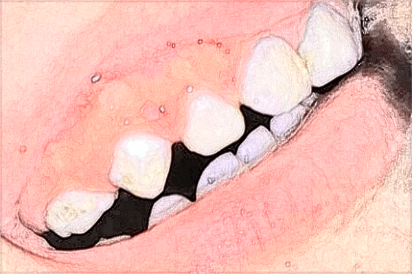 青島市立醫(yī)院拔智齒哪個(gè)醫(yī)生好?2024拔智齒醫(yī)生收費(fèi)價(jià)格