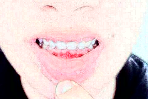 2024安徽省立醫(yī)院牙齒不齊矯正做的怎么樣_哪位醫(yī)生技術比較好