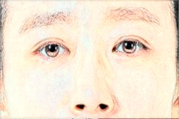 河北省人民醫(yī)院去眼袋需要多少錢?醫(yī)生推薦