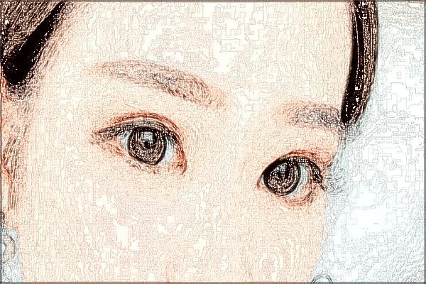 2024佛山市第二人民醫(yī)院去眼袋怎么樣?去眼袋手術恢復期