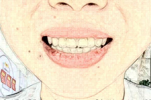 2024吉林大學(xué)第一醫(yī)院口腔科種植牙價格多少?做的怎么樣