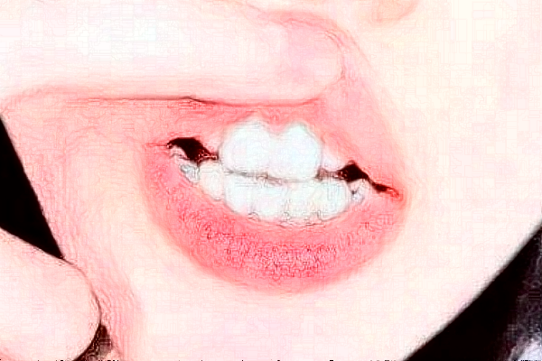 蘇北人民醫(yī)院牙齒美白價目表_口碑怎么樣