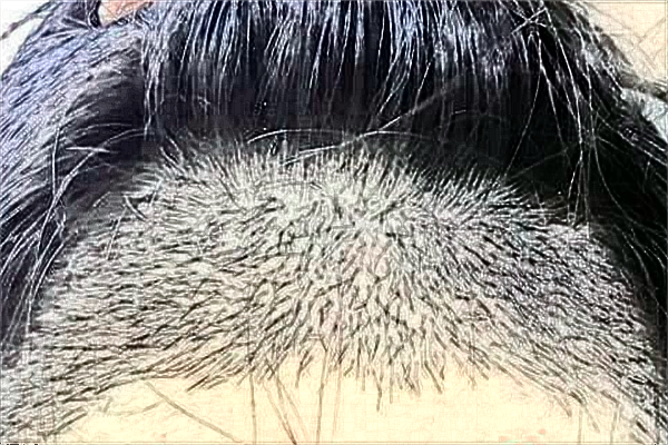 2024蘭州大學第二醫(yī)院植發(fā)多少錢?植發(fā)后還會脫落嗎