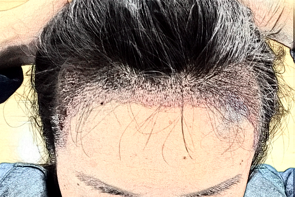 2024蘭州大學第二醫(yī)院植發(fā)多少錢?植發(fā)后還會脫落嗎