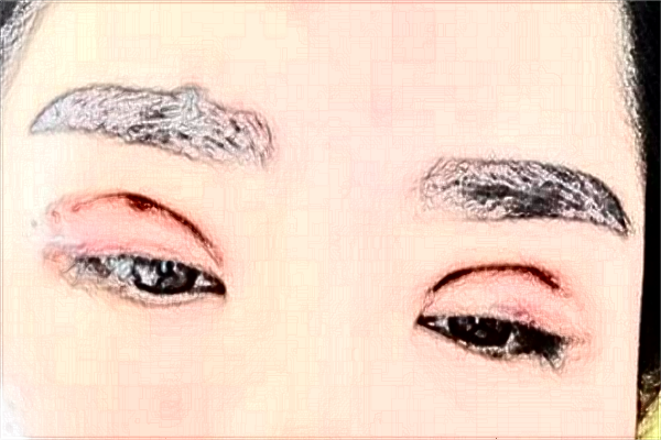 2024杭州市第一人民醫(yī)院埋線雙眼皮誰(shuí)做得好_需要多少錢