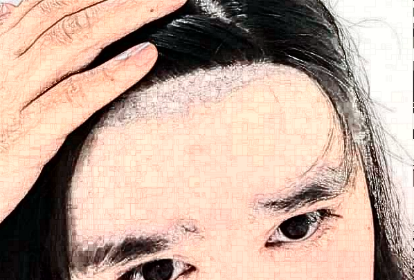 2024南京鼓樓醫(yī)院植發(fā)怎么樣_體驗日記分享