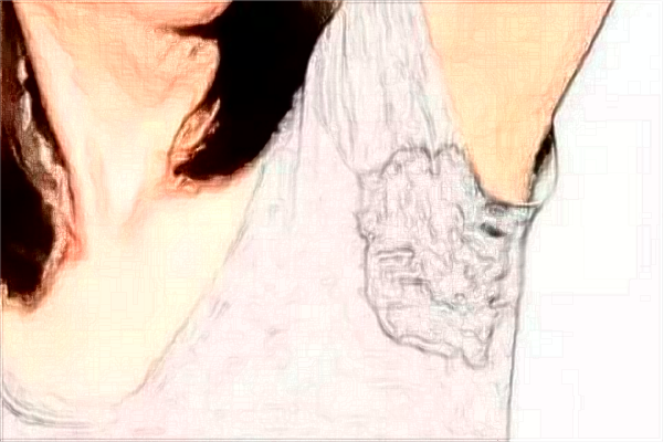 杭州市第一人民醫(yī)院去狐臭做的好嗎?案例反饋