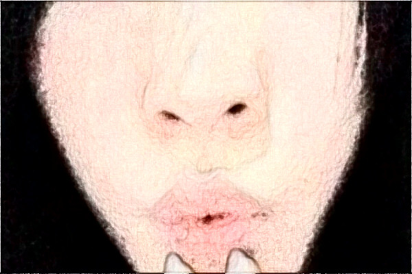 南京中大醫(yī)院激光去紅血絲怎么樣_整形日記分享