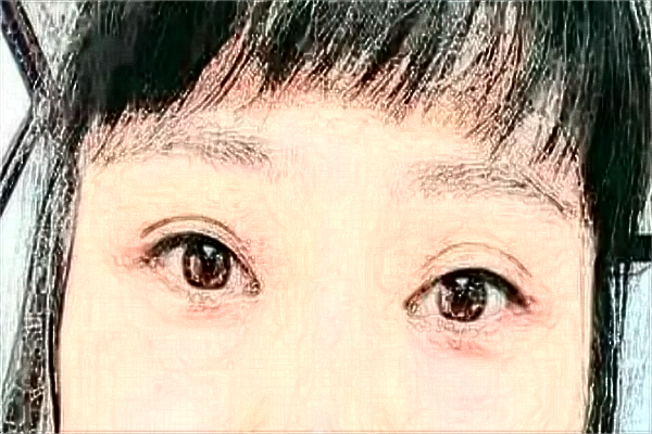 2024株洲市中心醫(yī)院雙眼皮手術(shù)收費價格?割雙眼皮好嗎