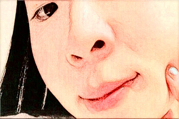 2024安徽省立醫(yī)院去胎記做的好嗎【去胎記案例反饋】