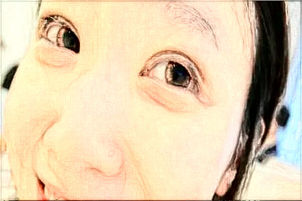 丹東市第一醫(yī)院割雙眼皮做的好嗎_案例_價(jià)格