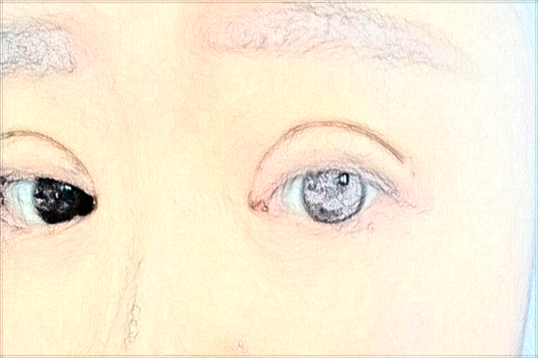 南通大學附屬醫(yī)院割雙眼皮價目表(價格表)怎么樣