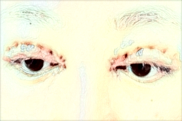 南通大學附屬醫(yī)院割雙眼皮價目表(價格表)怎么樣