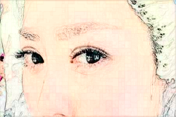 徐州醫(yī)科大學(xué)附屬醫(yī)院開眼角怎么樣_整形日記分享