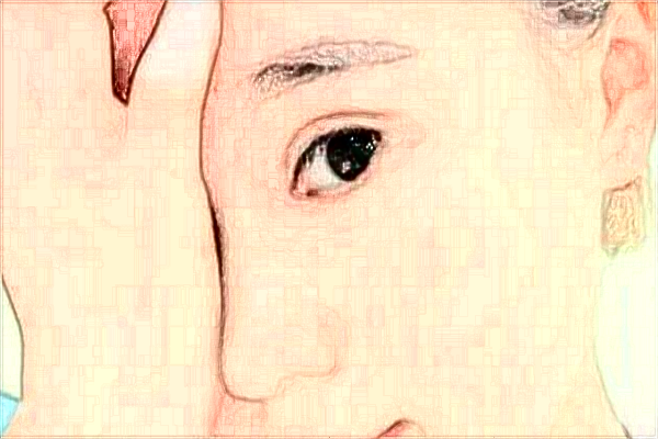 徐州醫(yī)科大學(xué)附屬醫(yī)院開眼角怎么樣_整形日記分享