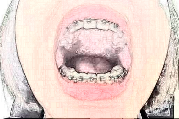 蘇州康美美容醫(yī)院牙齒種植費(fèi)用多少_真實(shí)案例反饋