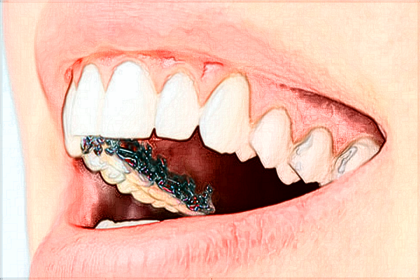 2024株洲市中心醫(yī)院根管要多少錢?根管推薦醫(yī)生