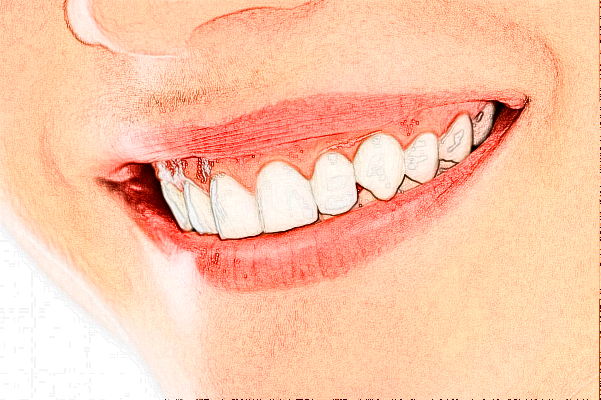 ??谑腥嗣襻t(yī)院種植牙怎么樣?種植牙有后遺癥嗎