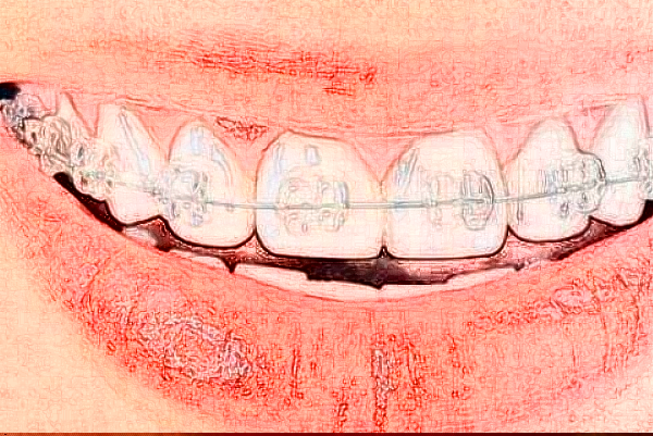 2024株洲市中心醫(yī)院矯正牙齒多少錢?矯正牙齒貴嗎