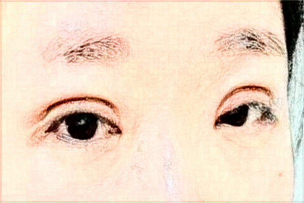 2024懷化市第一人民醫(yī)院飛秒價(jià)格?飛秒激光好不好?