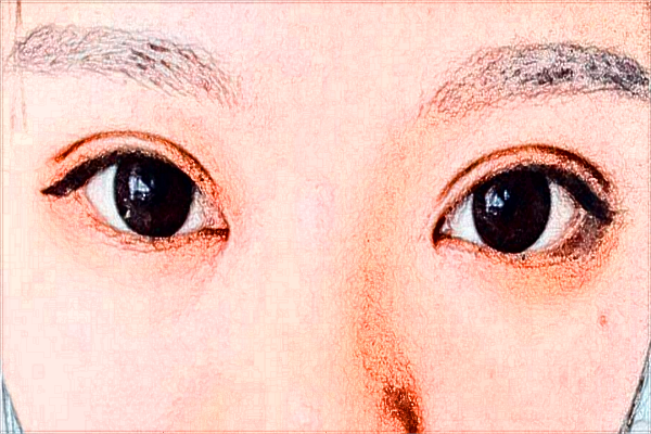 煙臺(tái)毓璜頂醫(yī)院整形美容科誰(shuí)做鼻子做得好?隆鼻案例