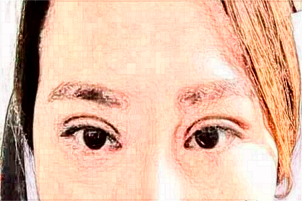 煙臺(tái)毓璜頂醫(yī)院整形美容科誰(shuí)做鼻子做得好?隆鼻案例