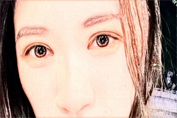 2024海口市人民醫(yī)院飛秒手術(shù)價(jià)格?飛秒手術(shù)后注意事項(xiàng)