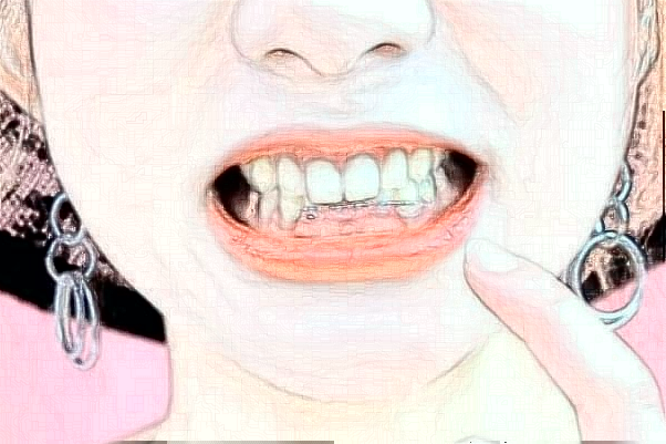 2024惠州市中心人民醫(yī)院拔牙費(fèi)用?虎牙矯正需要拔牙嗎