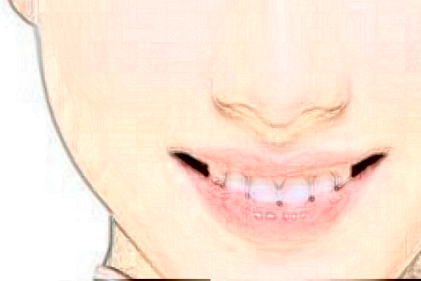 2024安徽醫(yī)科大學(xué)第一附屬醫(yī)院熱拉提怎么樣【熱拉提案例】