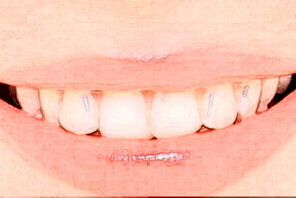 長(zhǎng)沙好大夫口腔醫(yī)院牙齒美容怎么樣_體驗(yàn)日記分享