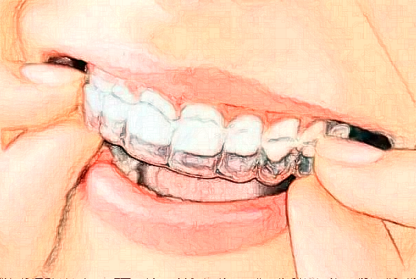 2024無錫市人民醫(yī)院烤瓷牙好嗎?附價格表+案例