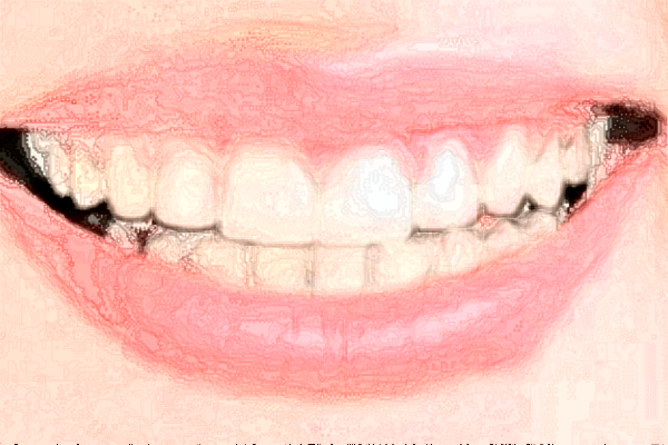 2024山西省人民醫(yī)院烤瓷牙費用多少?整形日記全過程