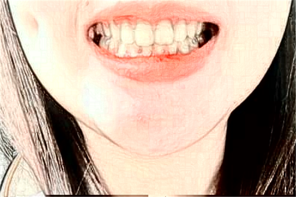 2024河北大學(xué)附屬醫(yī)院牙齒矯正多少錢(qián)_牙齒矯正醫(yī)生推薦